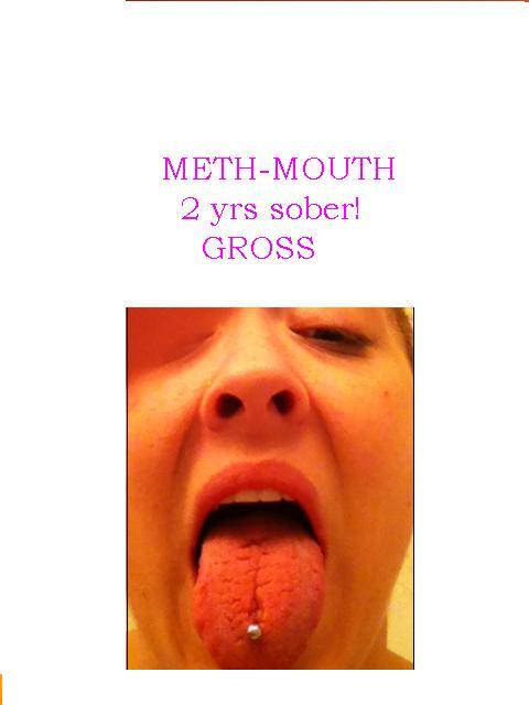 this is the permanent damage meth has done to my tongue!!!