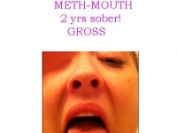 Meth-mouth, 2 yrs sober!!!!